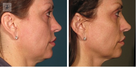 Rejuvenecimiento Facial: procedimientos no quirúrgicos