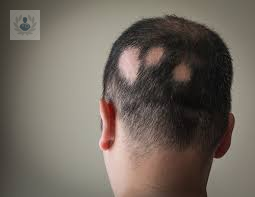 ¿Qué es la Alopecia?