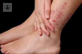Dermatitis Atópica: inflamación de la piel por Alergias (P3)