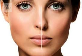 rinoplastia-cirugia-de-nariz-estetica-o-funcional-parte-3 imagen de artículo