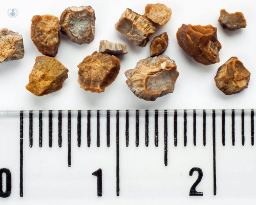 calculos-renales-causas-comunes-y-tratamiento-p1 imagen de artículo