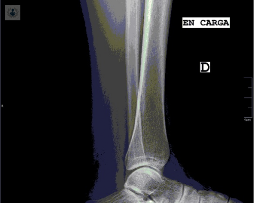 artroplastia-un-tratamiento-seguro-contra-la-artrosis-de-tobillo imagen de artículo