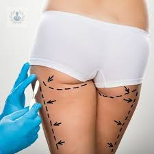 gluteoplastia-o-aumento-de-gluteos-con-implantes imagen de artículo