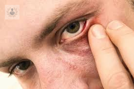 ojo-seco-sintomas-y-tratamiento imágen de artículo