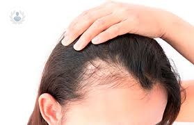 Caída de cabello exagerada o alopecia: causas y tratamiento (P1)