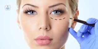 blefaroplastia-superior imagen de artículo