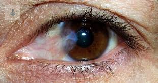 cirugia-de-ojos-por-catarata-el-tratamiento-mas-eficaz-p1 imagen de artículo