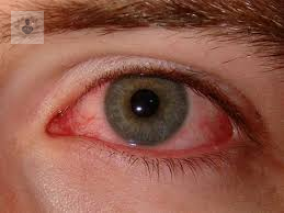 que-es-el-ojo-seco imagen de artículo