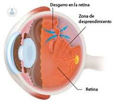 Desprendimiento de Retina: prevención y tratamientos (P2)