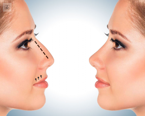 rinoplastia-funcional-y-estetico-recomendaciones-generales-p1 imagen de artículo