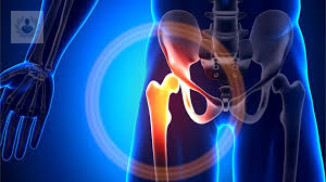 lesiones-de-cadera-causas-principales-y-tratamiento imagen de artículo