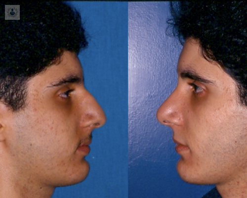 rinoplastia-tecnicas-y-cuidados-posoperatorios imagen de artículo