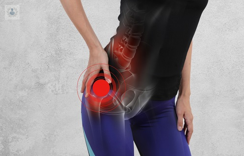 lesiones-de-cadera-causas-principales-y-tratamiento-p2 imagen de artículo