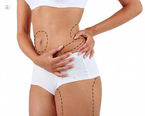 lipoescultura-todo-sobre-la-remodelacion-del-cuerpo-p3 imagen de artículo