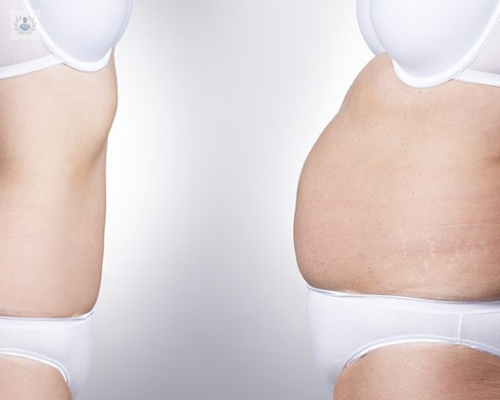 lipoescultura-todo-sobre-la-remodelacion-del-cuerpo-p4 imagen de artículo