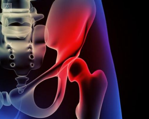 lesiones-de-cadera-causas-principales-y-tratamiento-p4 imagen de artículo
