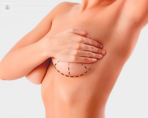 mamoplastia-de-aumento-materiales-y-ventajas-p1 imagen de artículo
