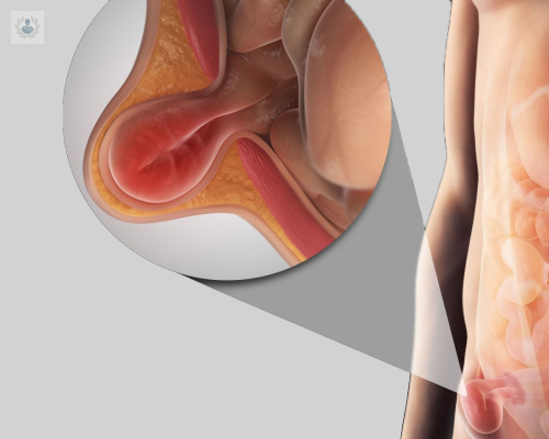 que-son-las-hernias-de-la-pared-abdominal imagen de artículo