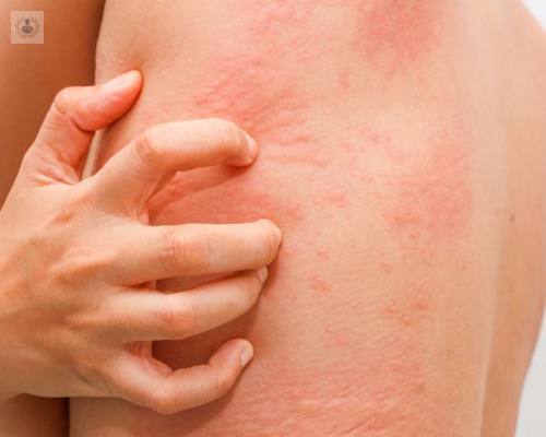 urticaria-cuales-son-sus-causas-y-tratamiento-p1 imagen de artículo