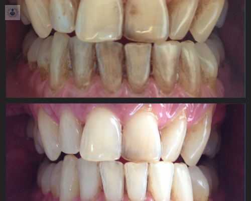 que-es-la-periodoncia-signos-de-alerta-de-la-enfermedad-tratamientos-y-beneficios-de-la-periodoncia-como-evitarla imagen de artículo