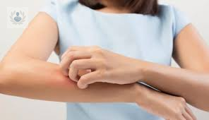 urticaria-cuales-son-sus-causas-y-tratamiento-p2 imagen de artículo