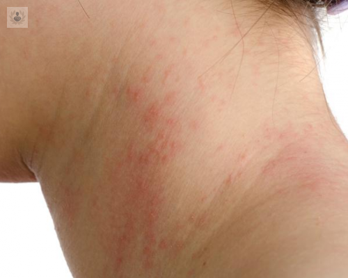 urticaria-cuales-son-sus-causas-y-tratamiento-p3 imagen de artículo