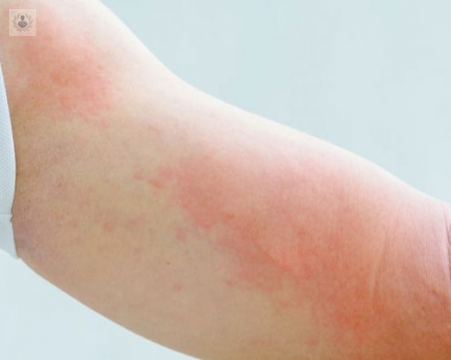 urticaria-cuales-son-sus-causas-y-tratamiento-p4 imagen de artículo
