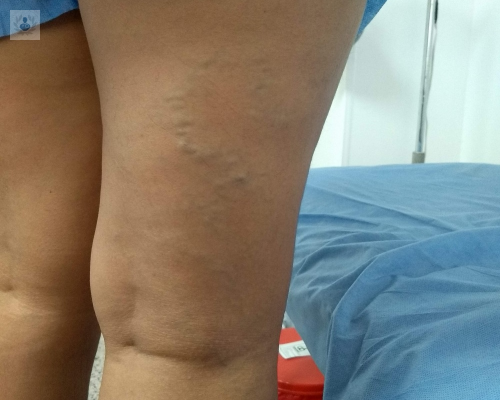 enfermedad-venosa-cronica-evc-factores-de-riesgo imagen de artículo