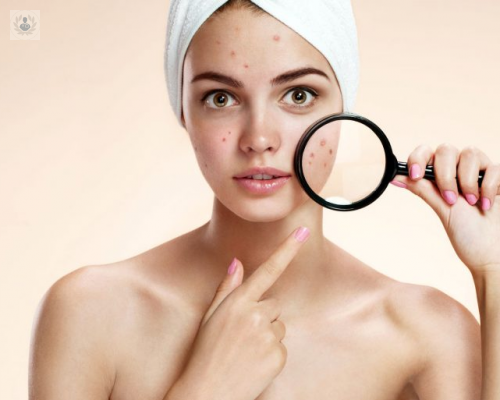 acne-factores-de-riesgo-y-evaluacion-clinica imagen de artículo