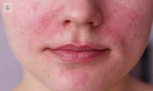 que-es-la-rosacea-sintomas-y-tratamiento imagen de artículo