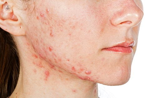 acne-en-la-adolescencia-y-edad-adulta imagen de artículo