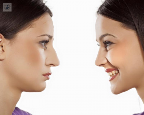 tipos-de-rinoplastia-funcional-y-estetica imagen de artículo