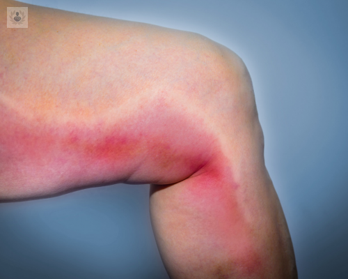 que-es-la-tromboflebitis-causas-diagnostico-y-tratamiento imagen de artículo