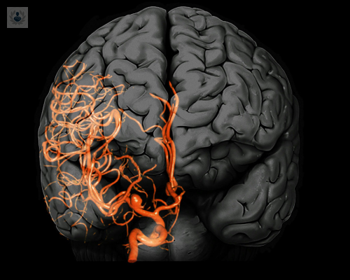 cirugias-vasculares-para-aneurismas-y-otros-padecimientos-p1 imagen de artículo