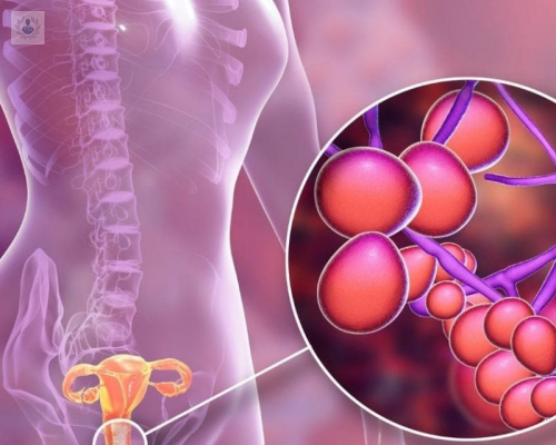 que-es-la-candidiasis-la-enfermedad-que-ataca-a-las-mujeres imagen de artículo