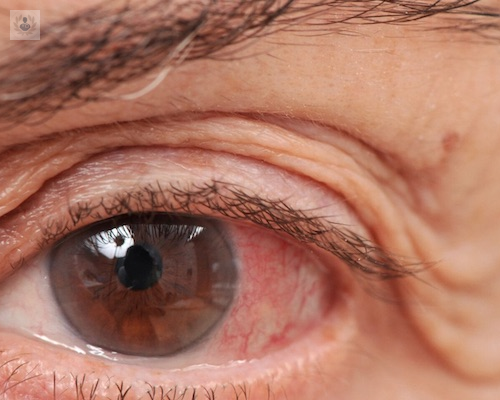 Es fácil tener Glaucoma, pero es más fácil saber si no se tiene