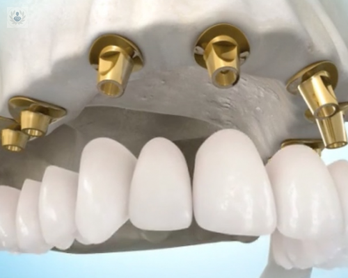 Instauración de la Tecnología Digital en los Implantes Dentales