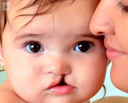 labio-y-paladar-hendido-como-comenzar-a-tratar-al-menor imagen de artículo