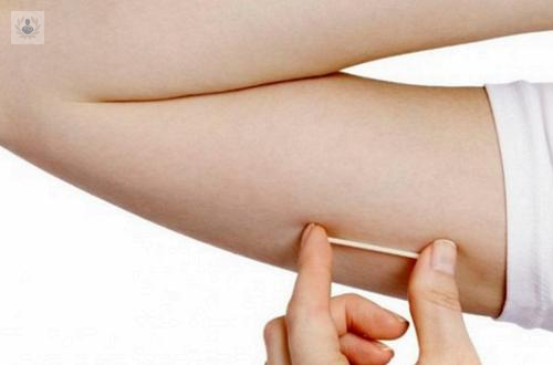 Implante Subdérmico: El Anticonceptivo que va bajo la piel
