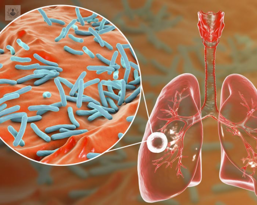 tuberculosis-5-claves-para-identificarla-y-evitar-el-contagio imagen de artículo