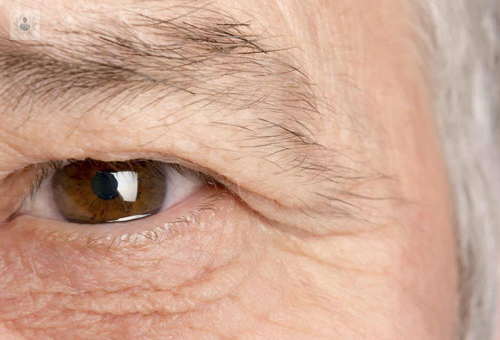 ¿Qué es el Glaucoma? Enfermedad relacionada con la Presión Ocular