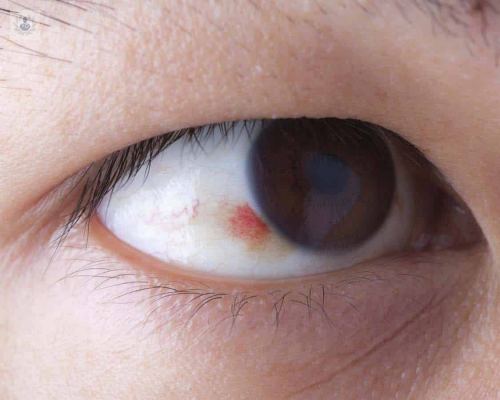 cuales-son-las-principales-causas-de-lesiones-en-la-cornea-en-ninos imagen de artículo