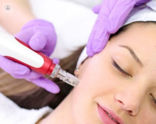 terapia-con-microagujas-para-rejuvenecimiento-facial-y-cuidado-de-la-piel imagen de artículo