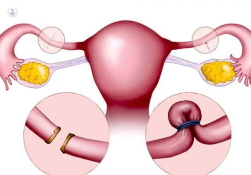 que-es-la-ligadura-de-trompas-conoce-los-detalles-sobre-esta-cirugia imagen de artículo