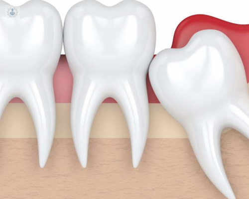 extraccion-de-cordales-una-forma-de-mejorar-la-higiene-y-prevenir-problemas-orales imagen de artículo
