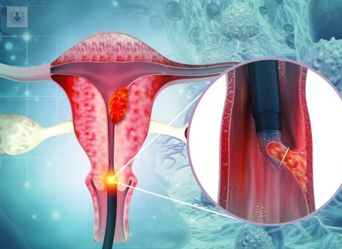Endometriosis ¿Cuáles son sus causas y formas de tratamiento?