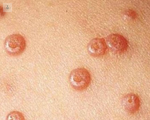 ¿Cuáles son los tipos más peligrosos del Virus del Papiloma Humano relacionado con Cáncer de Cuello Uterino?
