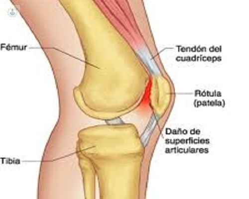 inestabilidad-en-la-rotula-que-lesiones-puede-provocar imagen de artículo