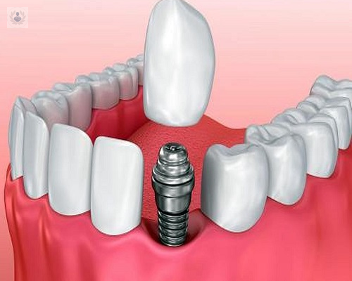 preguntas-mas-frecuentes-sobre-el-tratamiento-con-implantes-dentales imagen de artículo