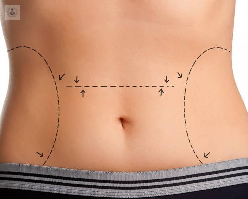 liposuccion-o-abdominoplastia-que-me-hago imagen de artículo